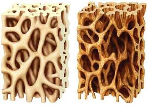 osteoporosi Gluten Free travel and Living