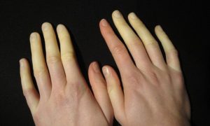 sclerodermia o sclerosi sistemica